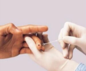 Test Rapide d'Orientation Diagnostic (TROD)